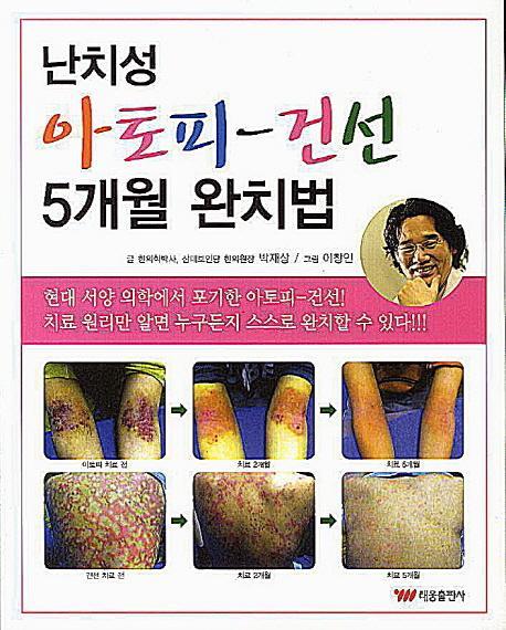 난치성 아토피 건선 5개월 완치법